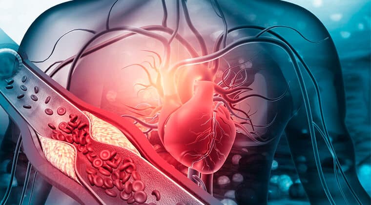 Cardiomiopatía isquémica