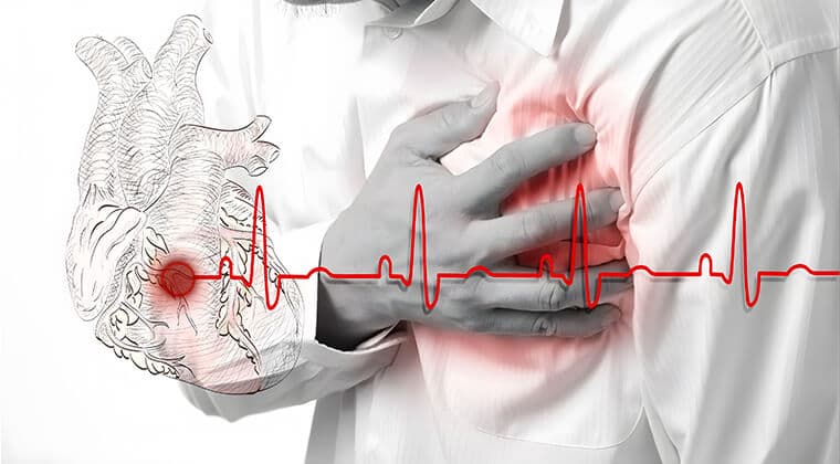 Infarto agudo de miocardio