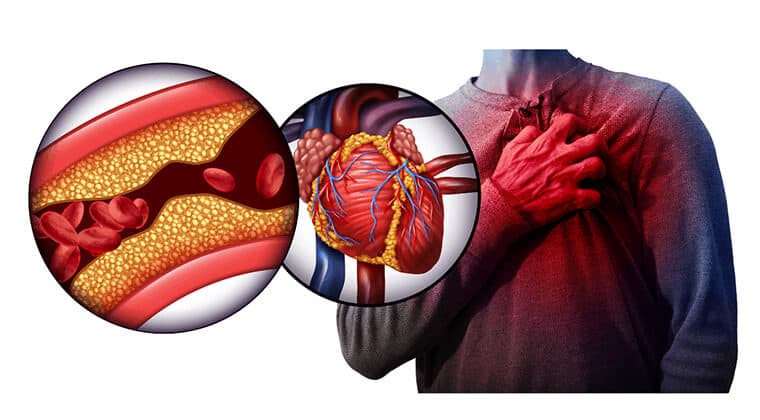 Infarto de miocardio