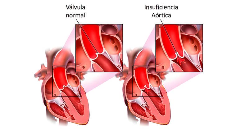 Insuficiencia aórtica