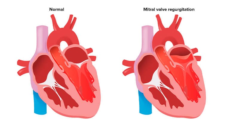 Insuficiencia mitral