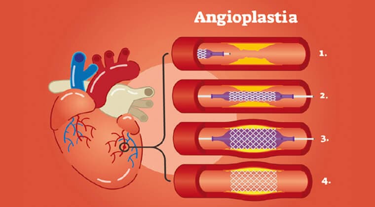 Angioplastia coronaria