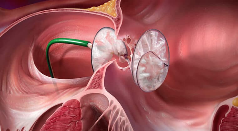 Cierre de comunicación interauricular o interventricular