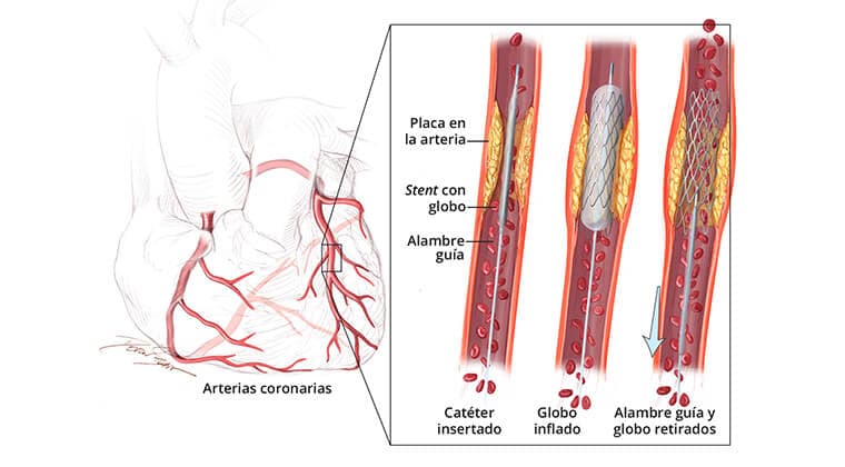 Colocación de stent