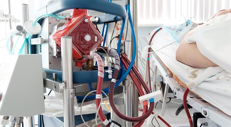 ECMO (oxigenación por membrana extracorpórea)